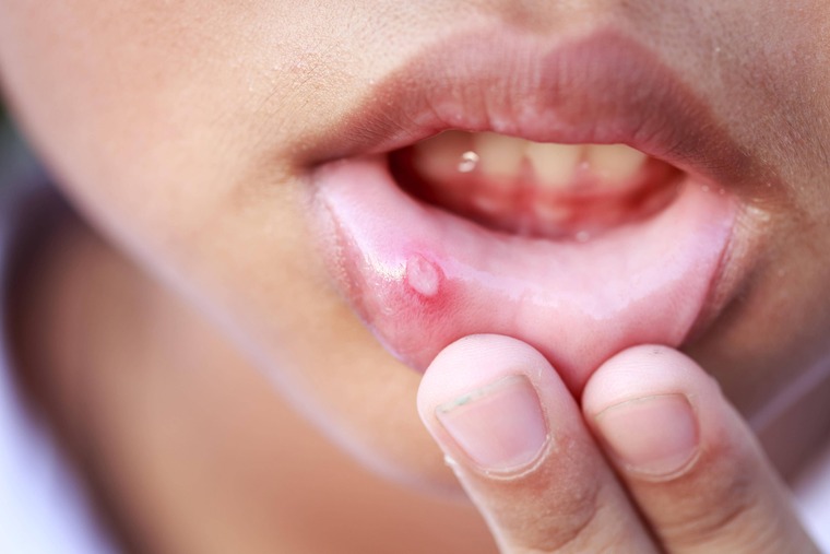 Oral Lesions Treatment